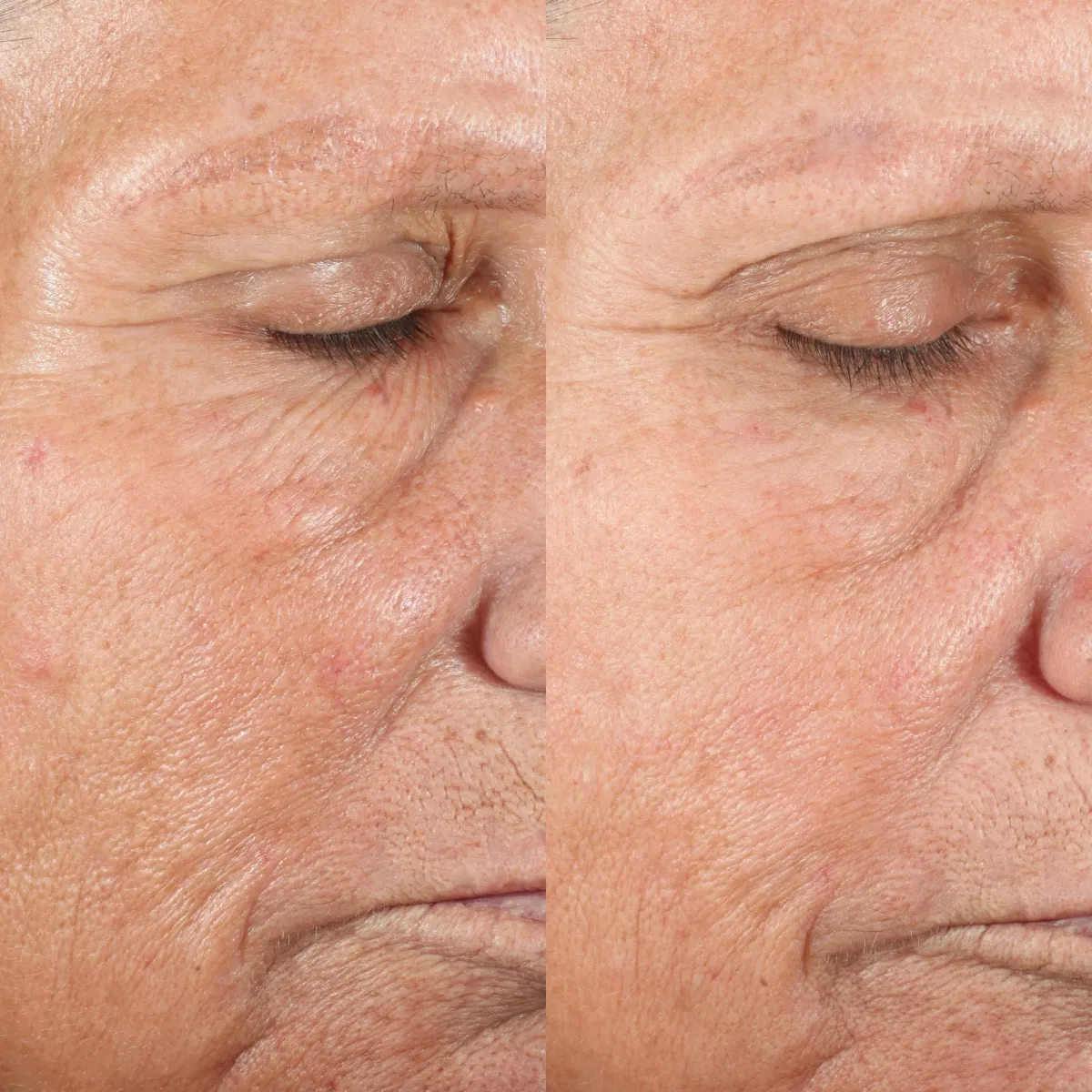 Microderm Elite Pro Personnel - caractéristiques