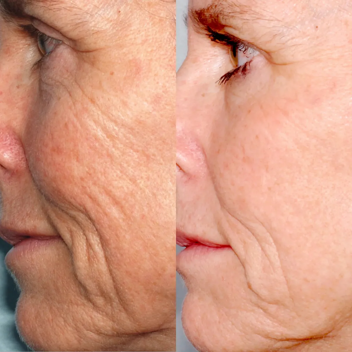 Microderm Pro Personnel - caractéristiques